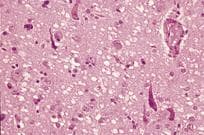 Nervous System Pathology sample question