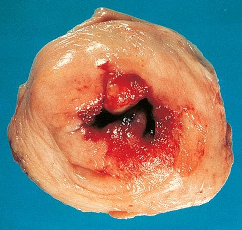 Female Genital Tract & Breast Pathology sample question